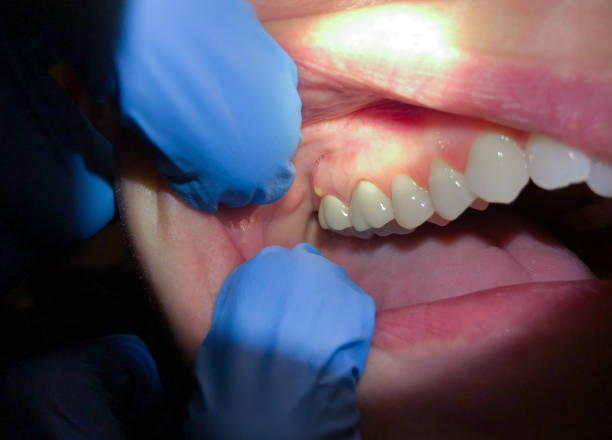 Best Emergency Dentist for Lost Fillings or Crowns in Shingletown, CA